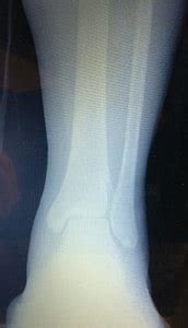 Broken Ankle Recovery Time: Diagnose How Long It Will Take!