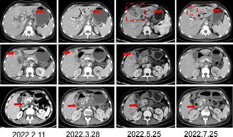 Frontiers | Advanced pancreatic cancer with KRAS wild-type and EGFR ...