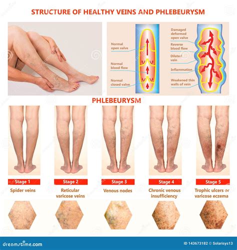 Thrombophlebitis. Deep Vein Thrombosis Stock Photo - Image of female ...