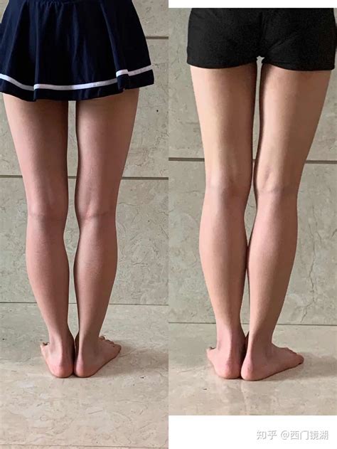 笔直大长腿 | XO腿追本溯源&对症下药篇足内翻足外翻 - 知乎