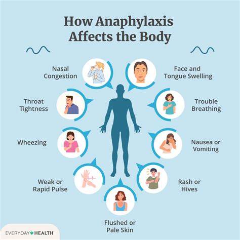 Anaphylaxis Without Swelling