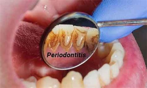 inflammatory bowel disease linked to severe Periodontitis