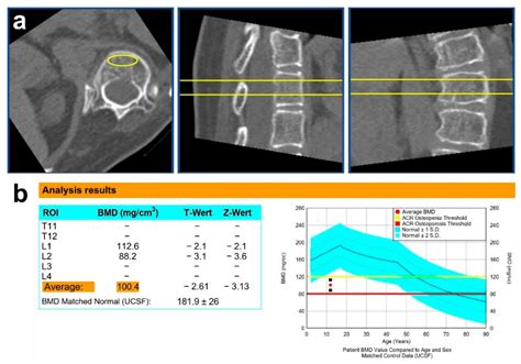 Reduced Volumetric Bone Mineral Density of the Spine in Adolescent Rett ...