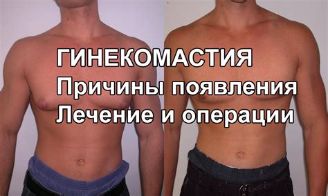 Гинекомастия у мужчин (МКБ-10 N62) - лечение, операция удаления, цена, фото