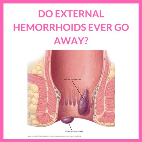 How Do External Hemorrhoids Look at Humberto Watts blog