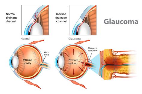 Is Glaucoma Curable