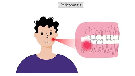 What are the Home Remedies for Pericoronitis? – NutritionFact.in