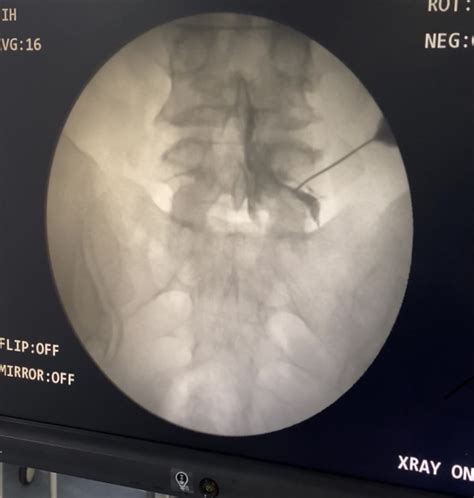 Image result for Selective Nerve Root Block