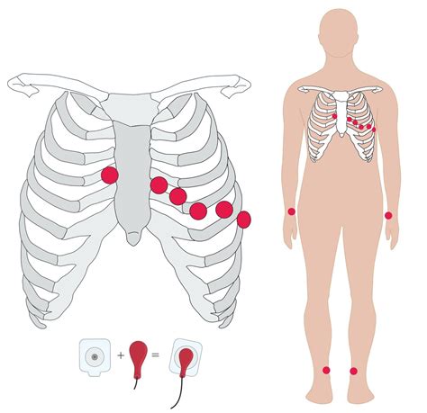 Ecg Electrodes Over Bone at Ellie Lowin blog