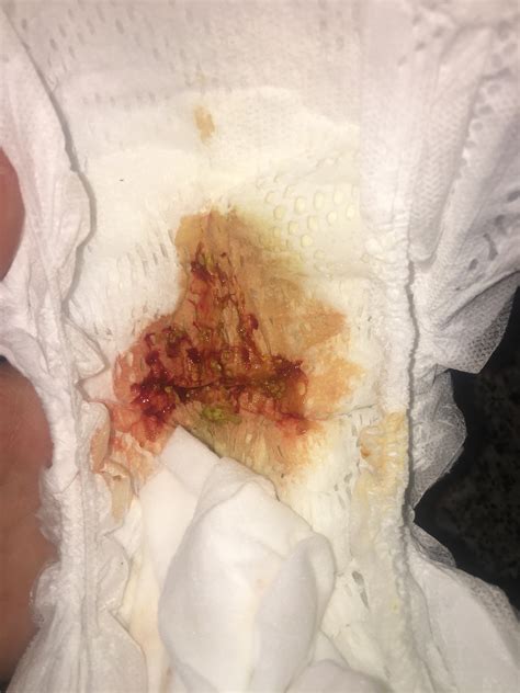 Severe Diaper Rash Bleeding
