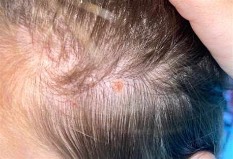 Signs Of Skin Cancer Scalp at Jonathan Landseer blog