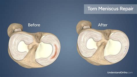 Torn Meniscus Repair – UnderstandOrtho™