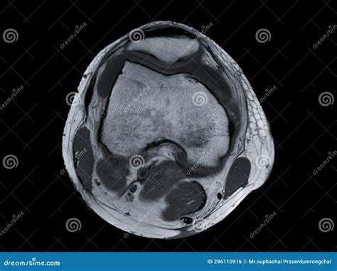 Mri Knee Axial