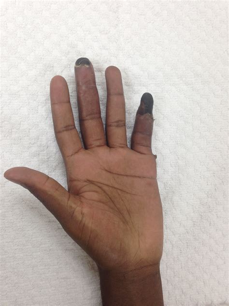 Frostbite finger injury in Miami? - Hands on Therapy