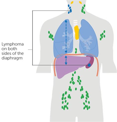 Hodgkin lymphoma causes, symptoms, diagnosis, stages, treatment & prognosis