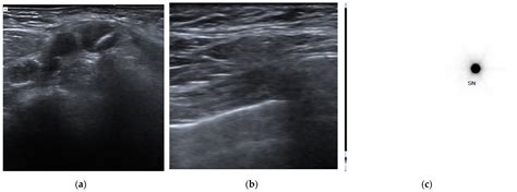 Selective Axillary Dissection after Neoadjuvant Chemotherapy in ...