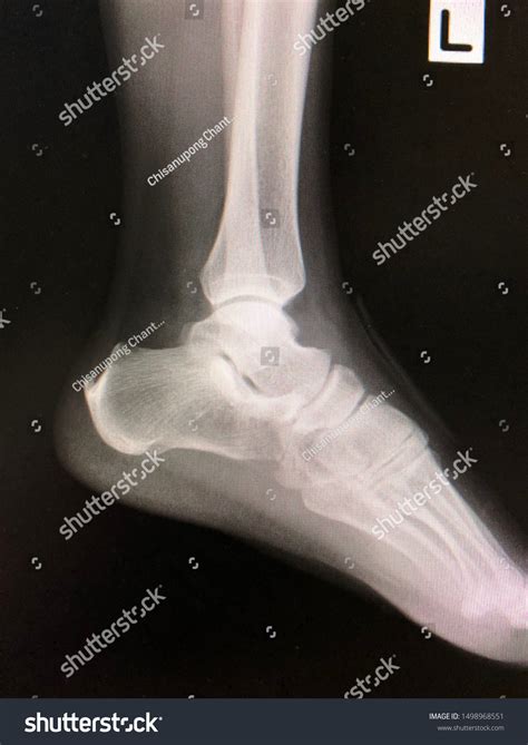 Normal Film Xray Left Ankle Lateral Stock Photo 1498968551 | Shutterstock