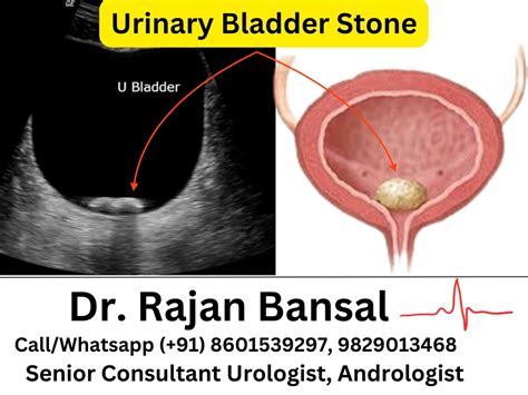 Urinary Bladder Stones - Diagnosis, and Treatment - Institute of Urology