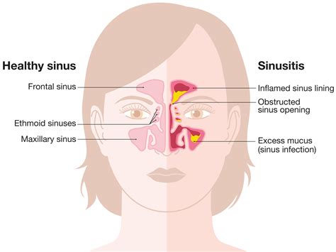 Sinus Infection Nose
