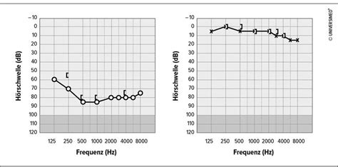 Therapie des Hörsturzes an der Universitätsklinik für Hals-, Nasen- un ...
