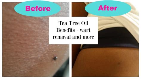 Image result for tea tree oil warts