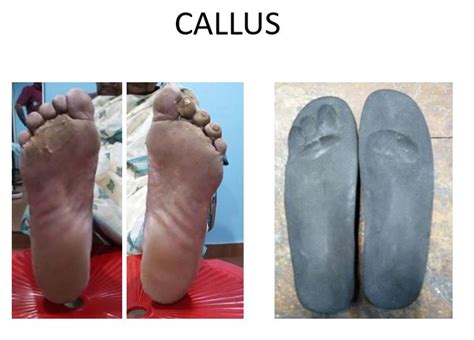 01-Feb-2021 Admin corns & callus, insoles