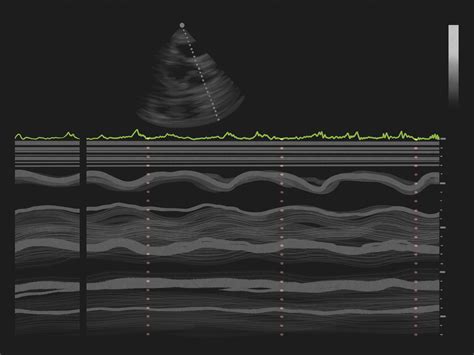 How to Interpret Echocardiograms: 8 Steps (with Pictures)