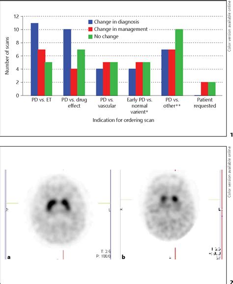 Image result for Dat SPECT Scan