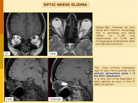 Optic Nerve Glioma