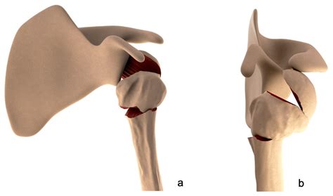 Posterior Head Injury