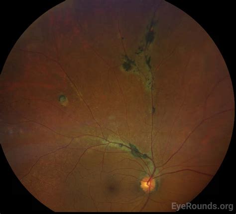 Pigmented Paravenous Retinochoroidal Atrophy