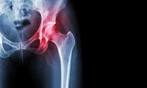 Corticosteroid injections of hip linked to 'rapidly destructive hip ...