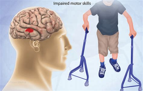 Image result for Apraxia Example