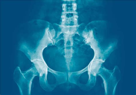 Si Joint Dysfunction X Ray at Karan Katz blog