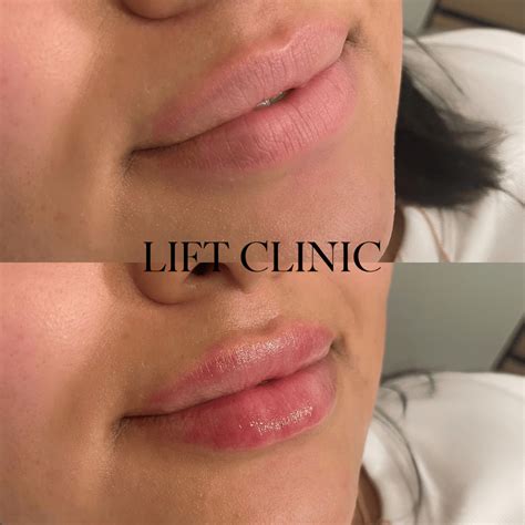 What Does 1ml of Lip Filler Look Like? 1ml Lip Fillers Before and After ...