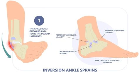 Ankle Sprains Treatment | Toronto Foot Care | Scarborough and North York