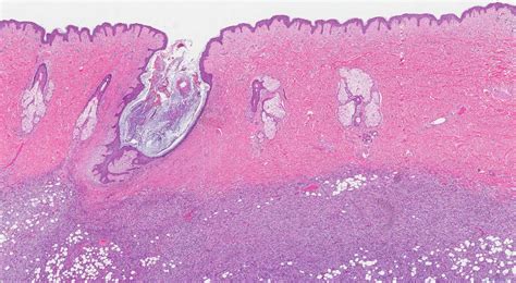 Image result for Dermatofibrosarcoma Protuberans