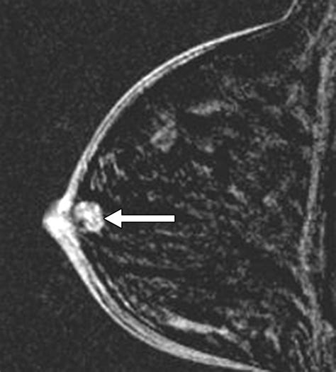 Papillary Lesions of the Breast: MRI, Ultrasound, and Mammographic Appearances | AJR