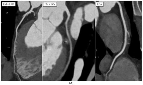 Computed Tomography Angiography as a Method for Diagnosing ...