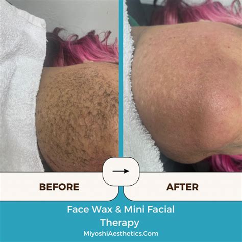 What is PCOS facial hair? Polycystic ovary syndrome (PCOS) is the most common hormone problem in ...