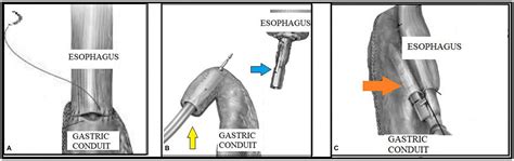 The evolution of anastomotic techniques in robot-assisted Ivor Lewis esophagectomy