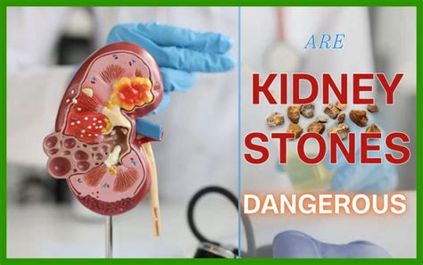 Kidney Stone Treatment
