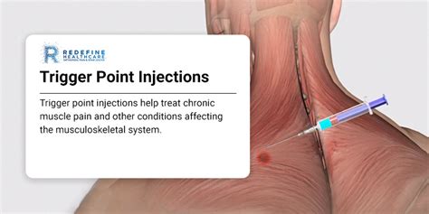Trigger Point Injections 的图像结果