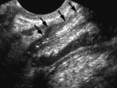 Rectovaginal Fistula Ultrasound