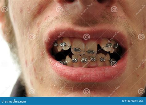 Close Up Of Crooked Teeth With Braces Stock Photography - Image: 11807202