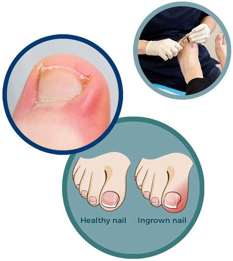 Do Ingrown Toenails Go Away