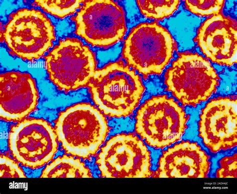 Epstein-Barr viruses, EBV. Coloured Transmission Electron Micrograph (TEM) of Epstein-Barr ...