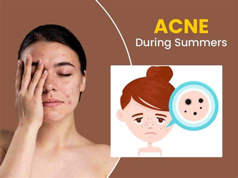 Acne in Summers Reason Cure Prevention | OnlyMyHealth