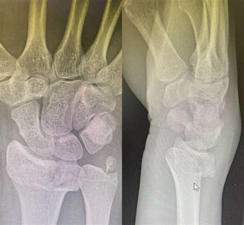 Wrist Fracture Surgery | London & Kent