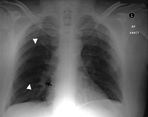 Westermark's and Palla's Signs in Acute Pulmonary Embolism | Circulation